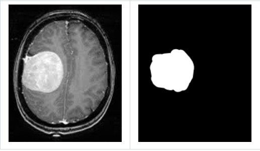 Brain Tumor Detection